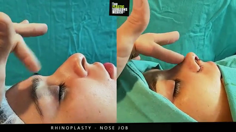 Nose Job - Rhinoplasty in Mexico - TopPlasticSurgeonsMexico 5